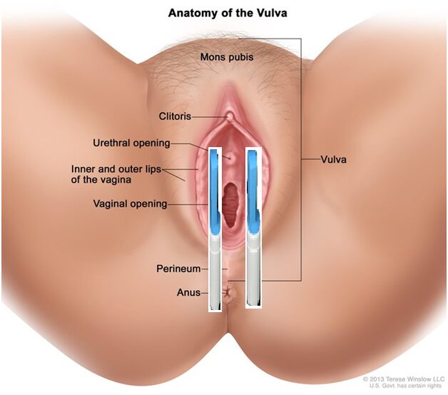 Aplicación en vestíbulo vulvar (2 zonas)